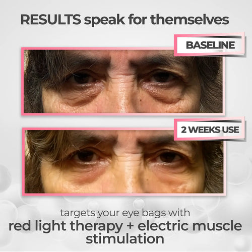 99Glow Bright Eyes™ | Red Light Under-Eye Glasses for Brighter, Rested-Looking Eyes